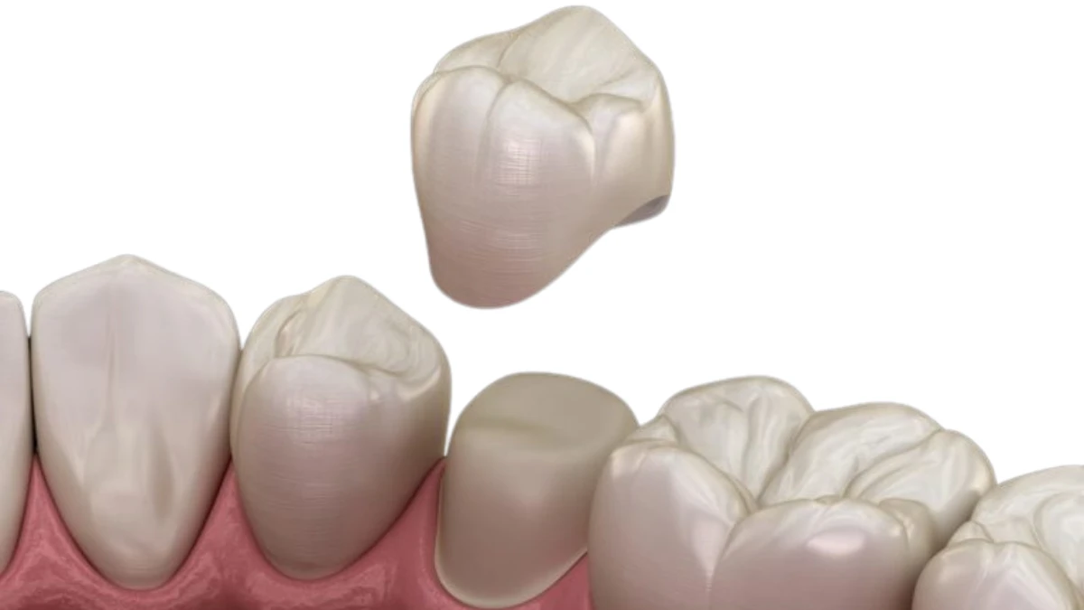 Dental Crowns Wasilla Dental Crowns Wasilla