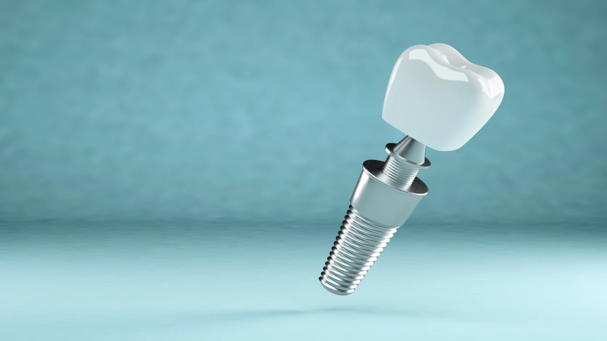 Dental Implants Procedure Wasilla, AK Dental Implants Procedure Wasilla, AK