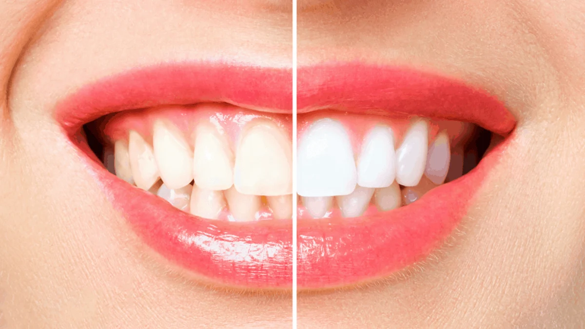 Professional Teeth Whitening Wasilla, AK Professional Teeth Whitening Wasilla, AK
