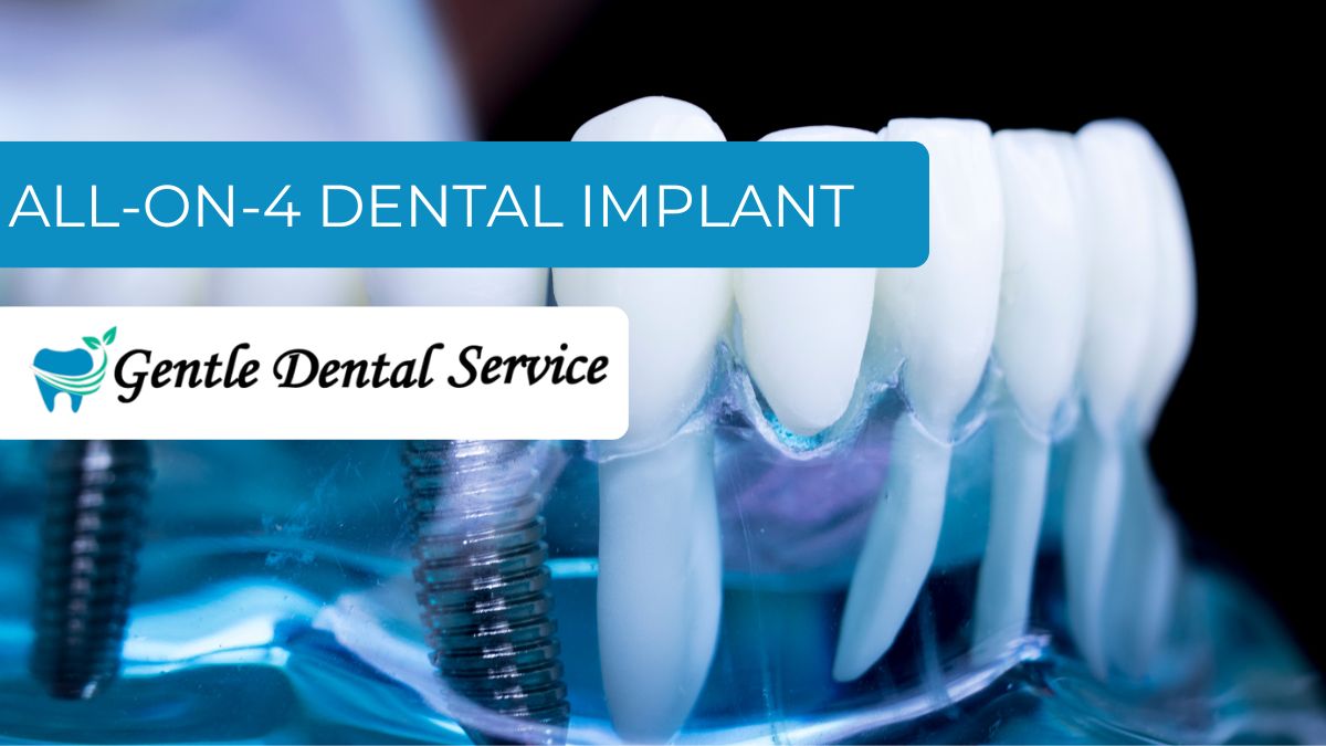 All-on-4® Dental Implants, Wasilla AK All-on-4® Dental Implants, Wasilla AK